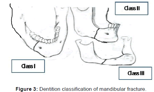 strejke Forblive Blive gift Newer Proposed Classification of Mandibular Fractures: A Critica