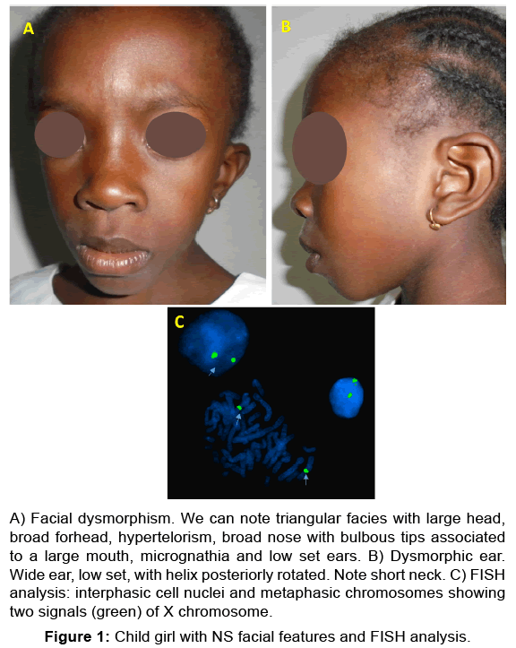 Clinical photos of the patients. (a) Case 1: Dysmorphic facial