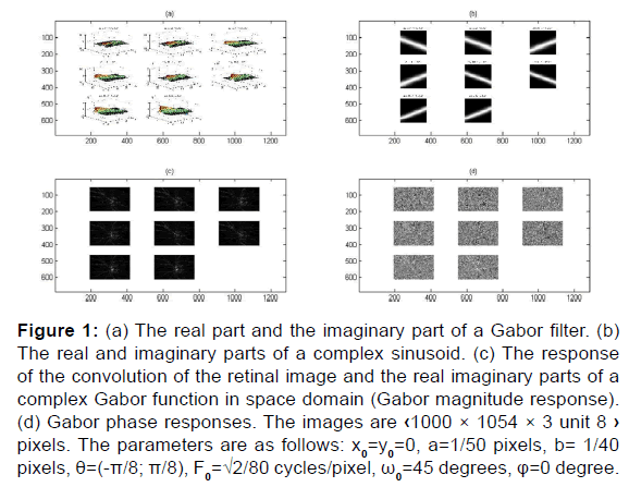 Applying Set of Gabor Filter to 2D-Retinal Fundus Image to Det