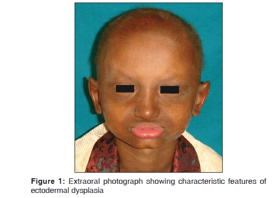 Hypohidrotic Ectodermal Dysplasia Symptoms