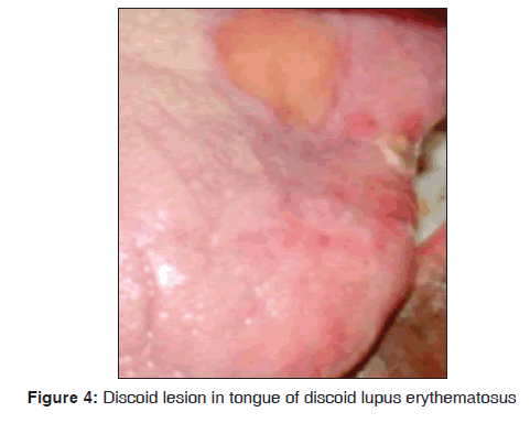 annals-medical-health-sciences-Discoid-lesion