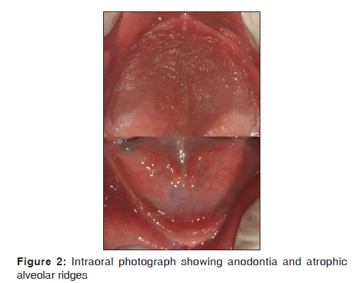 annals-medical-health-sciences-Intraoral-photograph