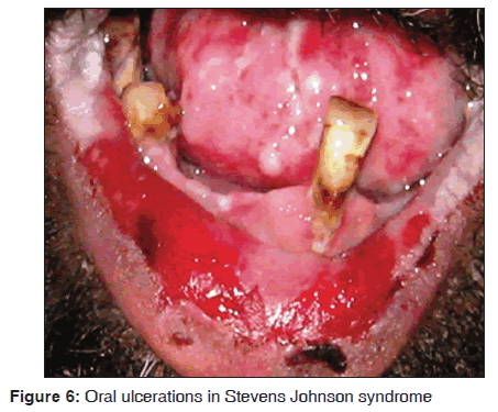 annals-medical-health-sciences-Johnson-syndrome