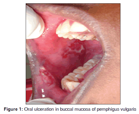 annals-medical-health-sciences-Oral-ulceration