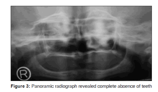 annals-medical-health-sciences-Panoramic-radiograph