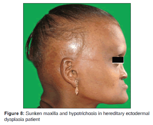 annals-medical-health-sciences-Sunken-maxilla