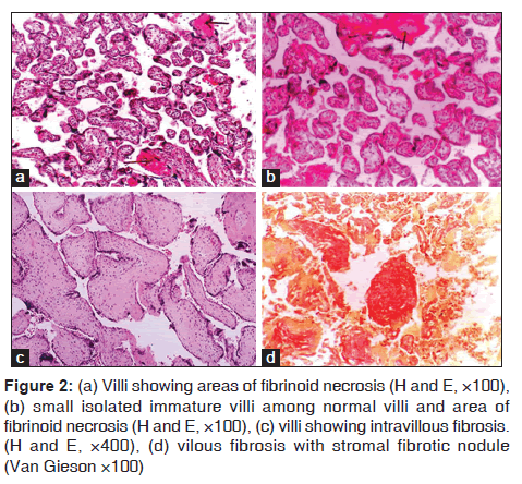 annals-medical-health-sciences-fibrinoid-necrosis