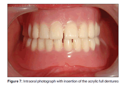 annals-medical-health-sciences-full-dentures