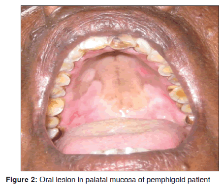 annals-medical-health-sciences-palatal-mucosa