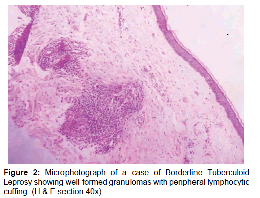 Annals-Medical-Borderline-Tuberculoid