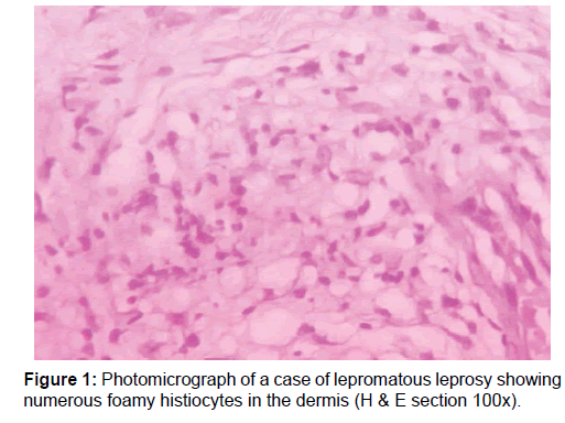 Annals-Medical-lepromatous-leprosy