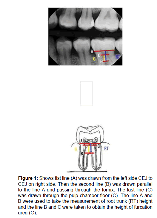 Radiographic Assessment Of Tooth Furcation Area Measurements Bef