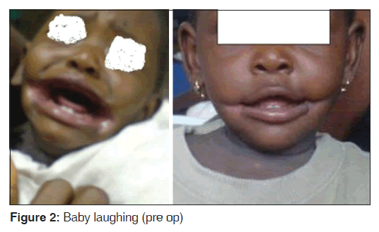 annals-medical-health-Baby-laughing