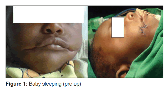 transverse facial cleft