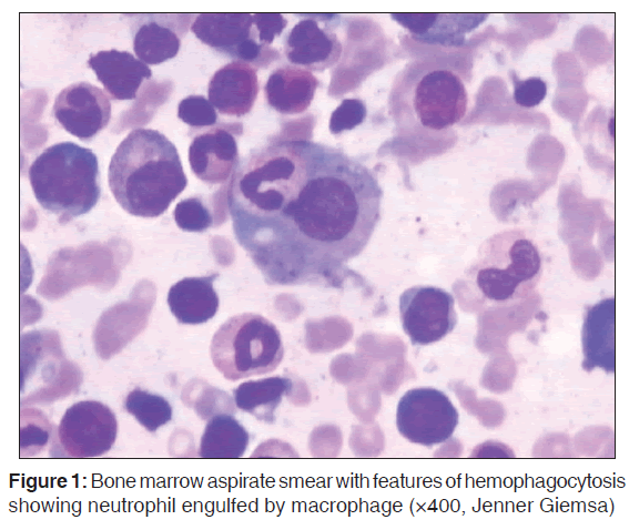 annals-medical-health-Bone-marrow-aspirate