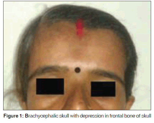annals-medical-health-Brachycephalic-skull
