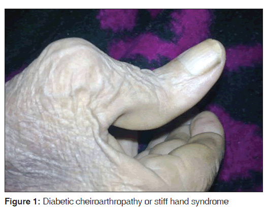 annals-medical-health-Diabetic-cheiroarthropathy