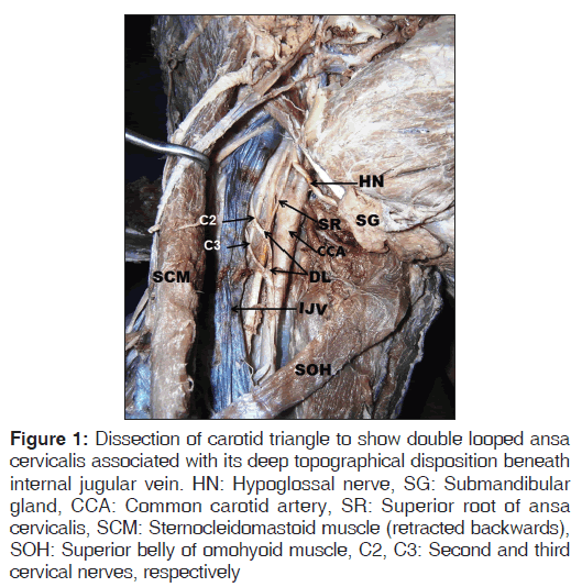 annals-medical-health-Dissection-carotid-triangle