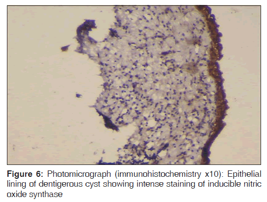 annals-medical-health-Epithelial-lining-dentigerous