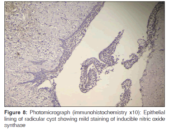 annals-medical-health-Epithelial-lining-radicular