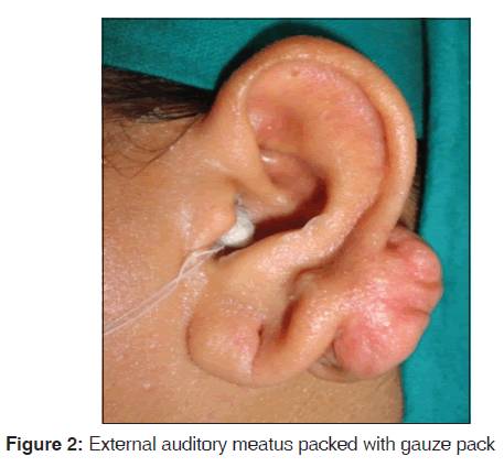annals-medical-health-External-auditory-meatus