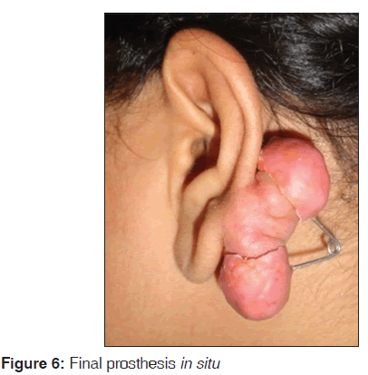 Pressure Earring as an Adjunct to Surgical Removal of Earlobe Keloids -  SAVION - 2009 - Dermatologic Surgery - Wiley Online Library