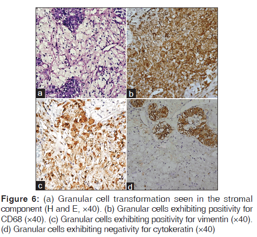 annals-medical-health-Granular-cell-transformation