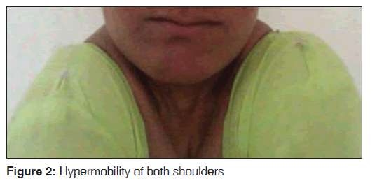 annals-medical-health-Hypermobility-shoulders