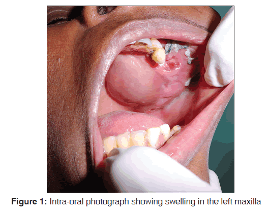annals-medical-health-Intra-oral-photograph