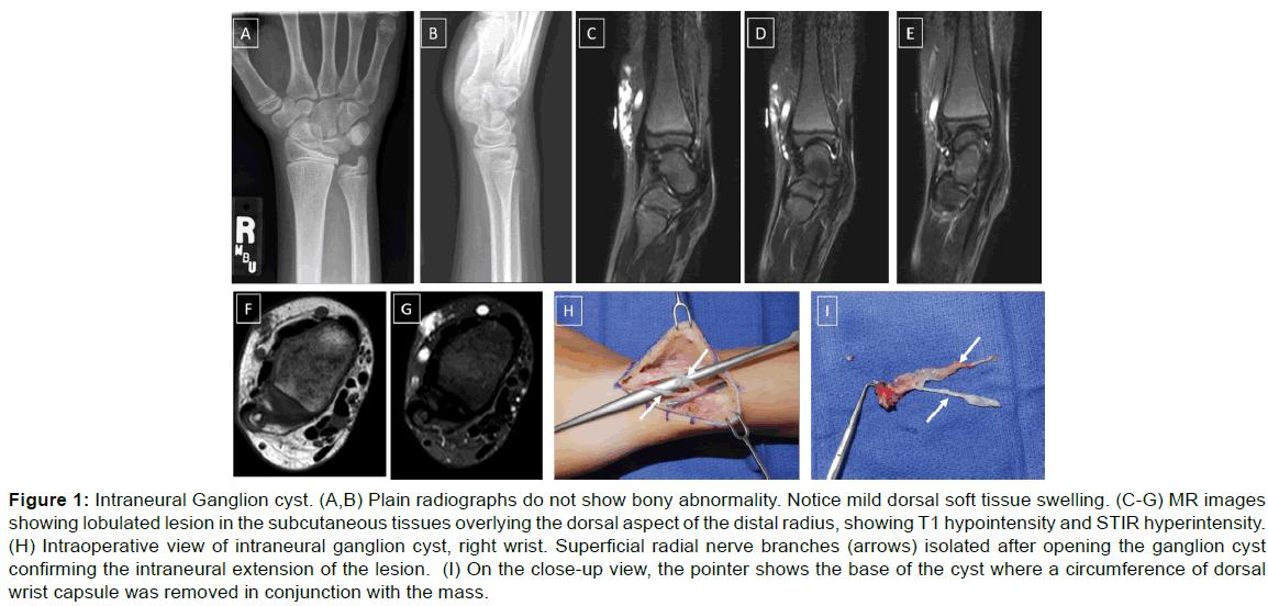 annals-medical-health-Intraneural-Ganglion