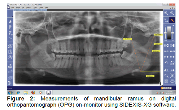 annals-medical-health-Measurements-mandibular-ramus