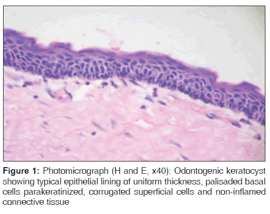 annals-medical-health-Odontogenic-keratocyst