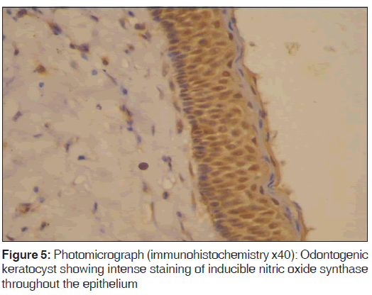 annals-medical-health-Odontogenic-keratocyst