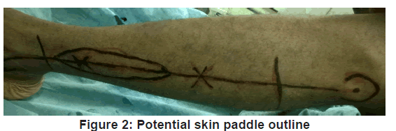 annals-medical-health-Potential-skin-paddle