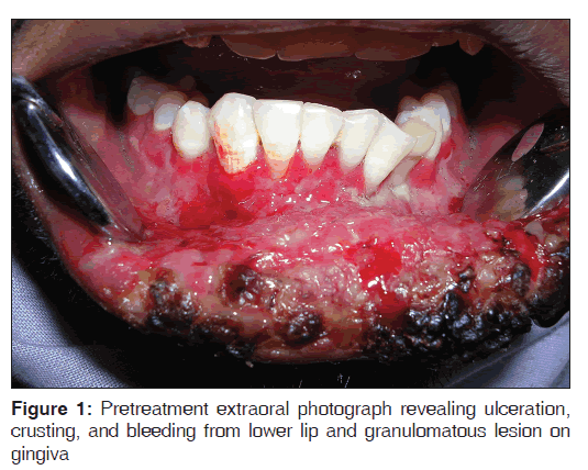 annals-medical-health-Pretreatment-extraoral