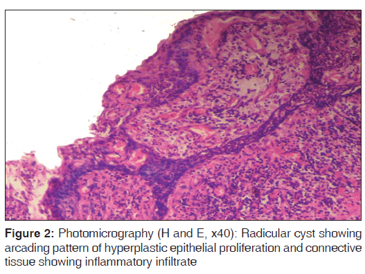 annals-medical-health-Radicular-cyst