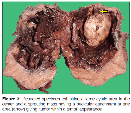 annals-medical-health-Resected-specimen