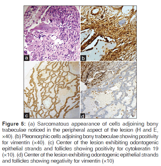 annals-medical-health-Sarcomatous-appearance