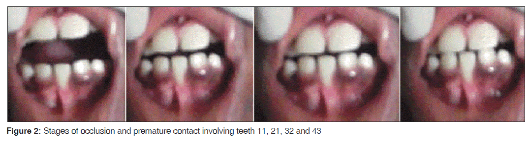 annals-medical-health-Stages-occlusion