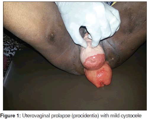 annals-medical-health-Uterovaginal-prolapse