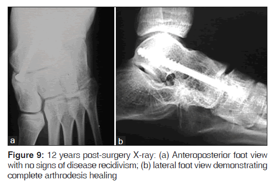 annals-medical-health-arthrodesis-healing