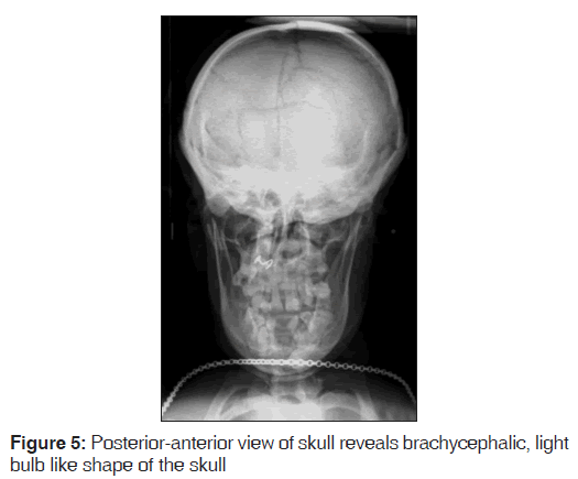 annals-medical-health-clavicular-hypoplasia