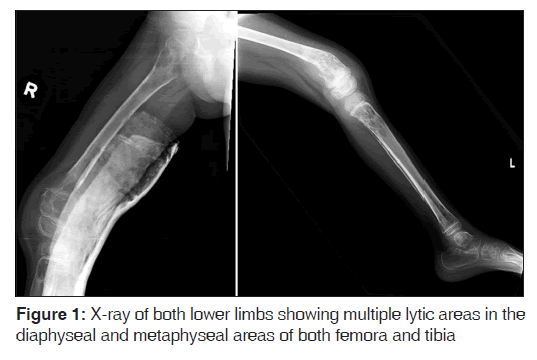 annals-medical-health-diaphyseal-metaphyseal