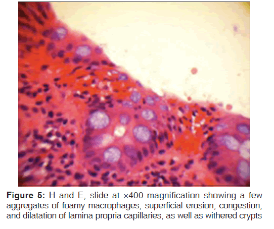 annals-medical-health-foamy-macrophages