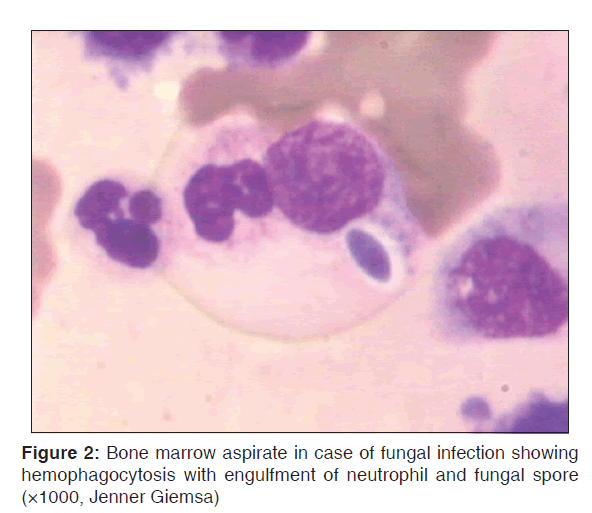 annals-medical-health-fungal-infection-showing