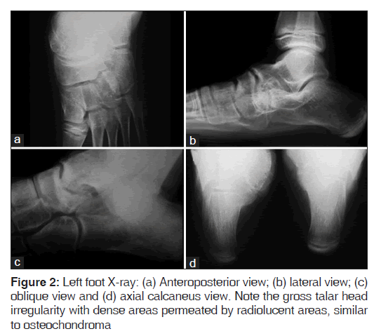 annals-medical-health-gross-talar-head-irregularity