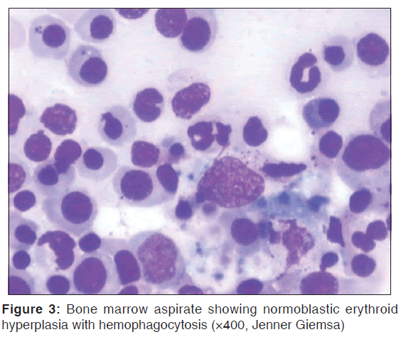 annals-medical-health-hemophagocytosis