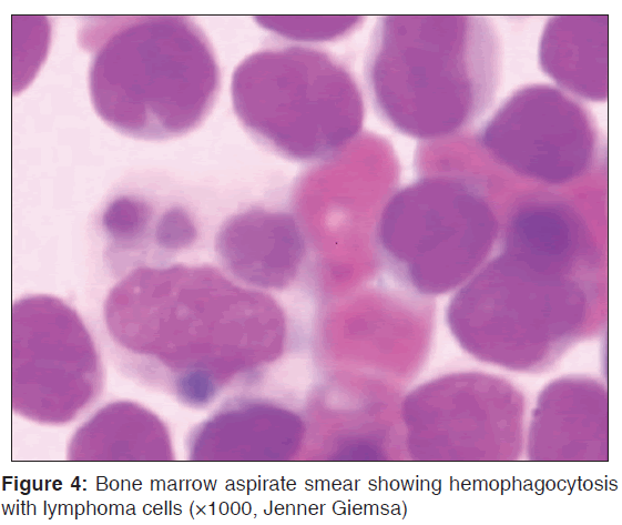 annals-medical-health-hemophagocytosis-lymphoma