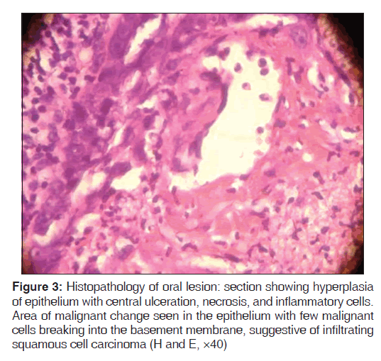 annals-medical-health-hyperplasia-epithelium