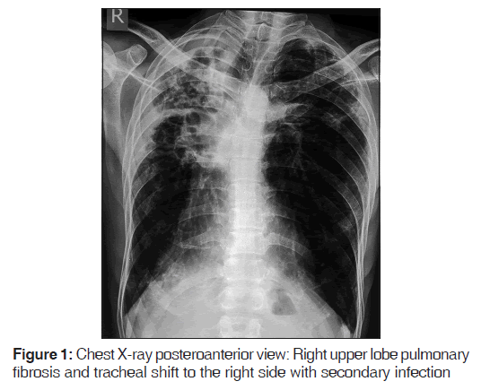 annals-medical-health-lobe-pulmonary-fibrosis